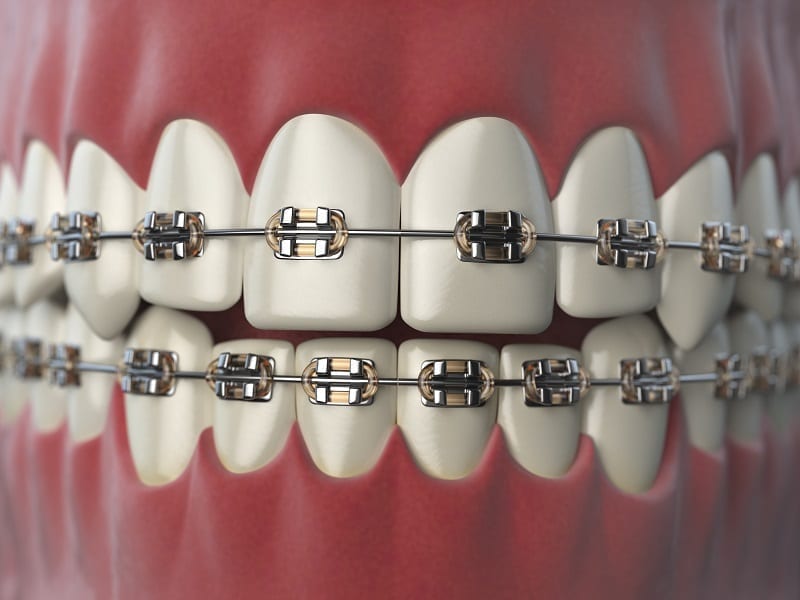 Dental braces
